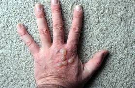 خسارت تب برفکی دامدارانی که بیمه باشند پرداخت می‌شود